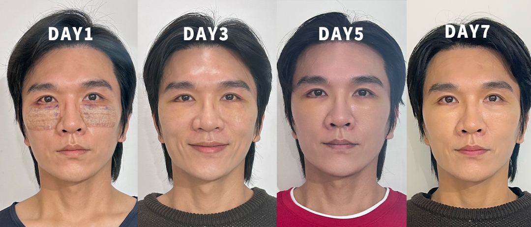 眼袋手術一週恢復紀錄